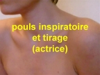 Pouls inspiratoire et tirage